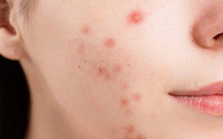 5 tips bij acne