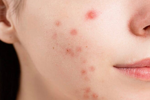 5 tips bij acne